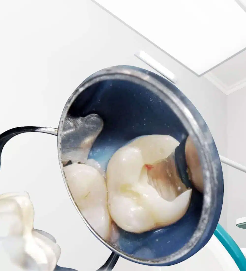 Endodontie et dévitallisation à Bruxelles - iDent-clinic