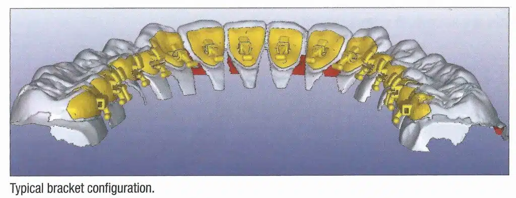 Advantages of lingual orthodontics in Brussels - iDent Clinic
