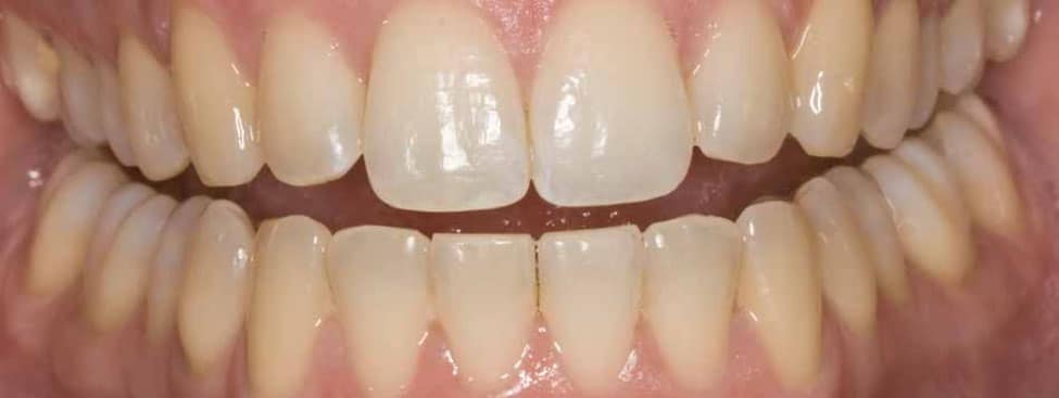 Example of teeth whitening in Brussels before