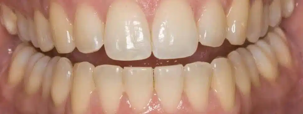 Example of teeth whitening in Brussels before