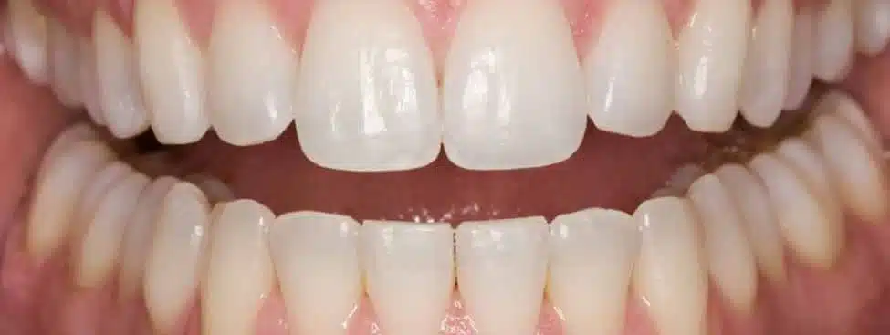 Example of teeth whitening in Brussels - result