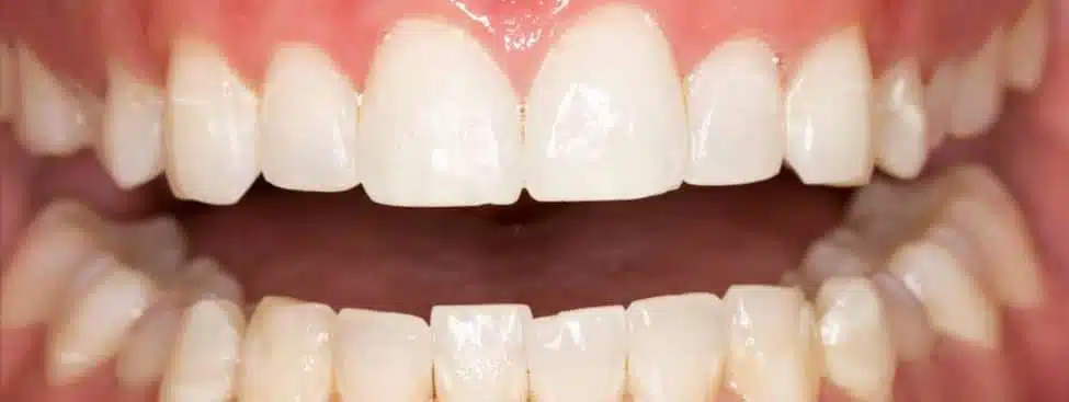 Voorbeeld van tanden bleken in Brussel - resultaat