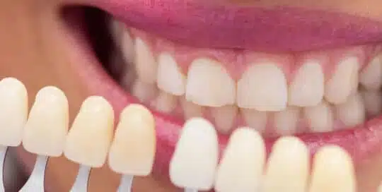 Teeth whitening in Brussels - iDent Clinic