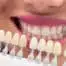 Teeth whitening in Brussels - iDent Clinic