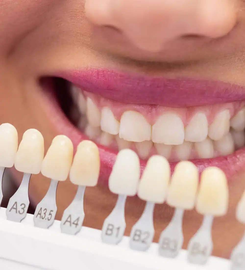 Teeth whitening in Brussels - iDent Clinic