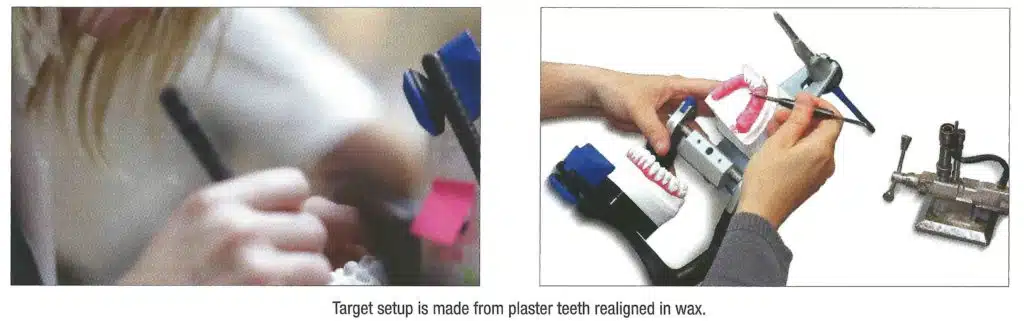 Lingual orthodontic impression in Brussels - iDent Clinic