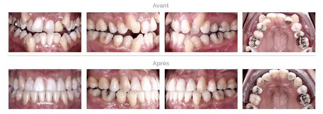 Treatment of catastrophic teeth in Brussels with Invisalign
