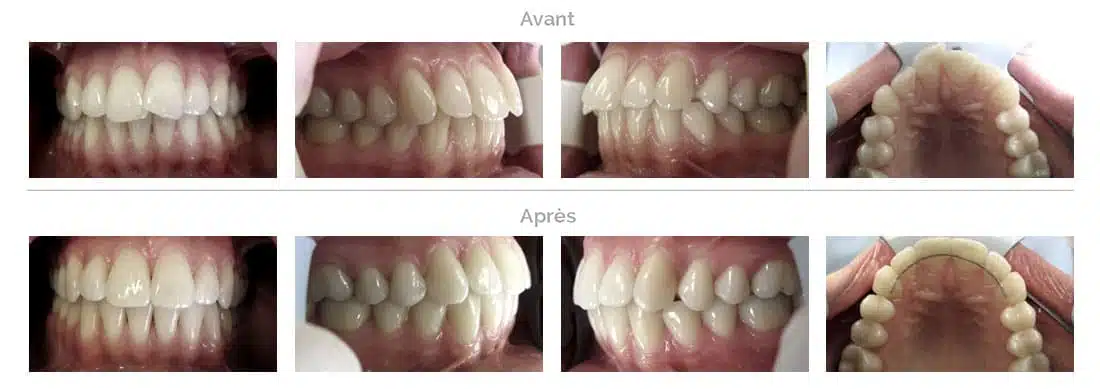 Traitement Invisalign chevauchement léger des dents