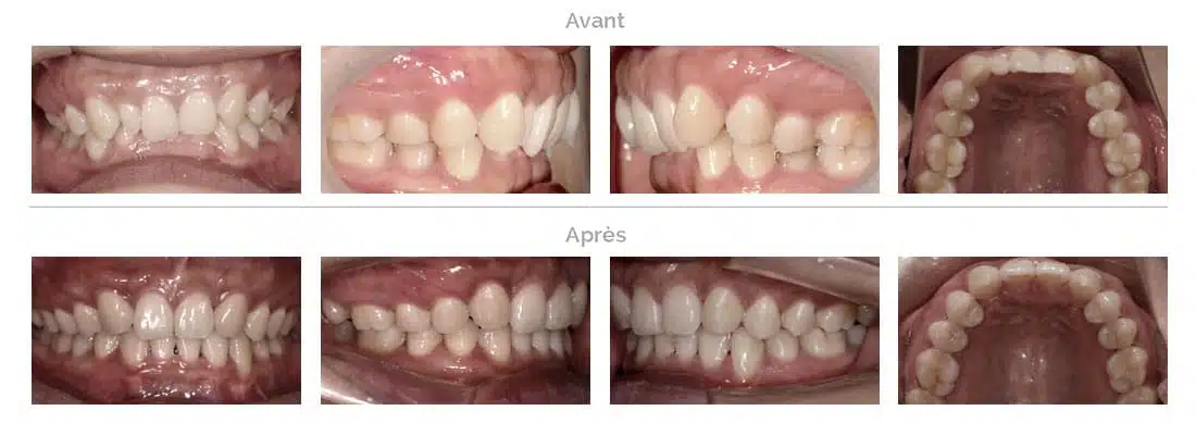 Invisalign deepbite-behandeling in Brussel