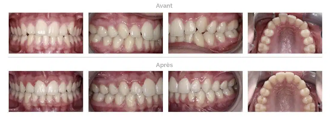 Invisalign treatment of crooked teeth