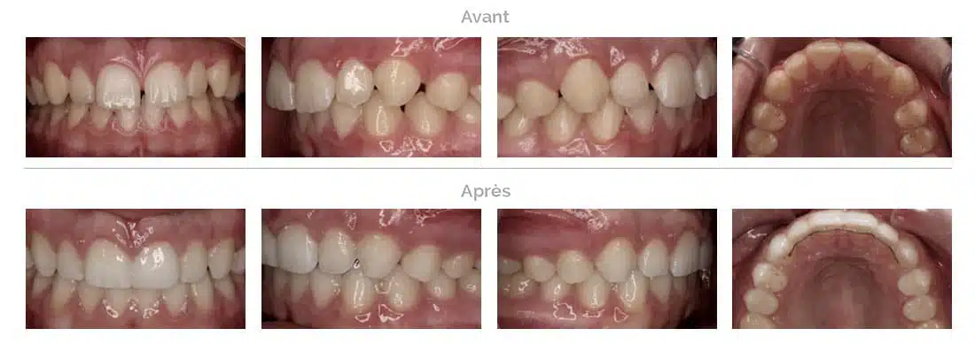 Traitement de diastème avec Invisalign à Bruxelles