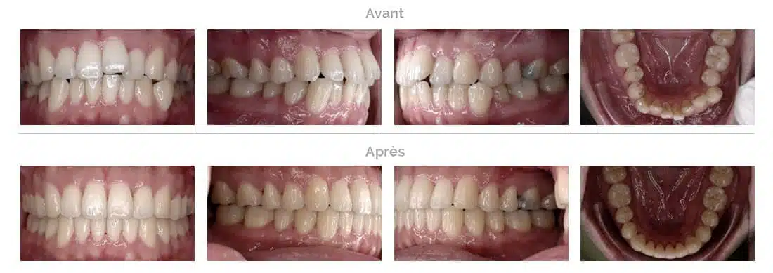 Invisalign treatment in Brussels large overlapping teeth 