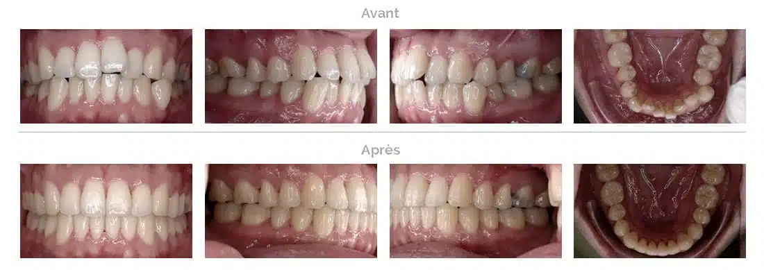 Invisalign-behandeling in Brussel grote overlappende tanden 