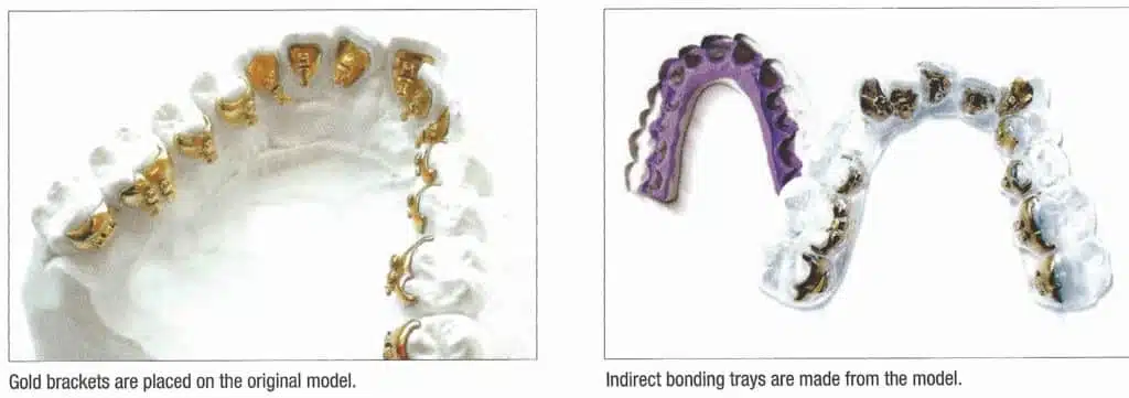 Manufacturing of lingual orthodontics in Brussels - iDent Clinic