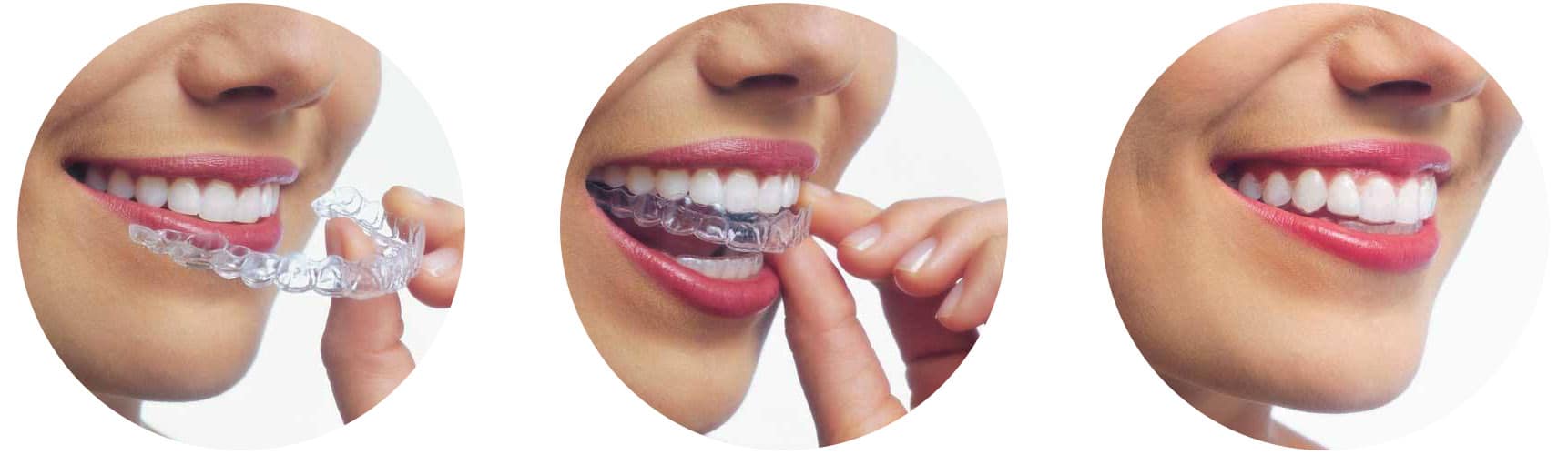 Orthodontic treatment in Brussels - open bite