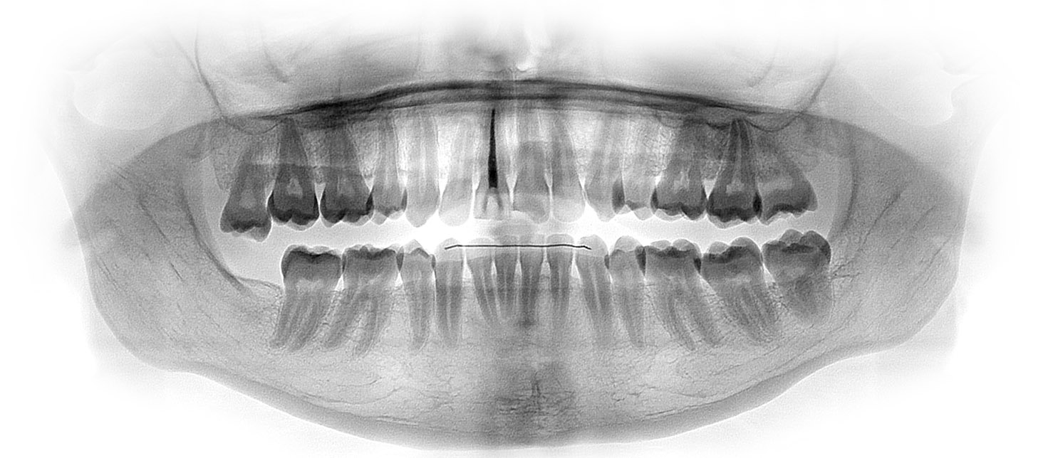 Traitement orthodontie à Bruxelles - béance