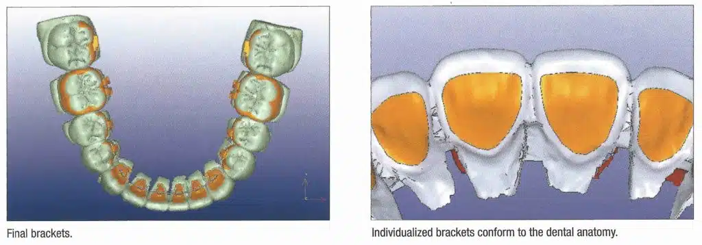 Positionering van linguale orthodontie in Brussel - iDent Clinic