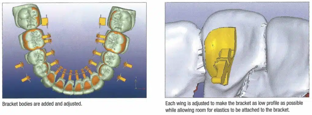 Positionering van linguale orthodontie in Brussel - iDent Clinic