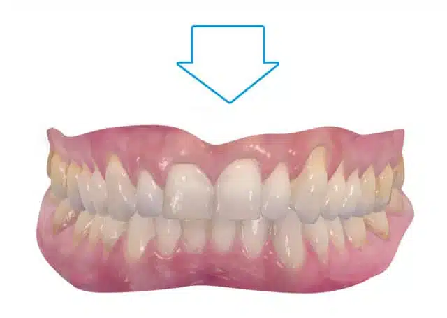 Orthodontic treatment in Brussels - open bite