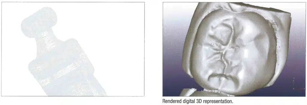 Linguale orthodontische scan in Brussel - iDent Clinic