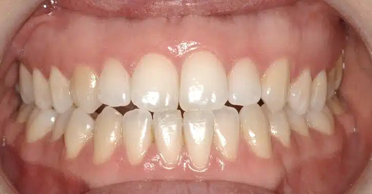 Orthodontische behandeling in brussel - end to end