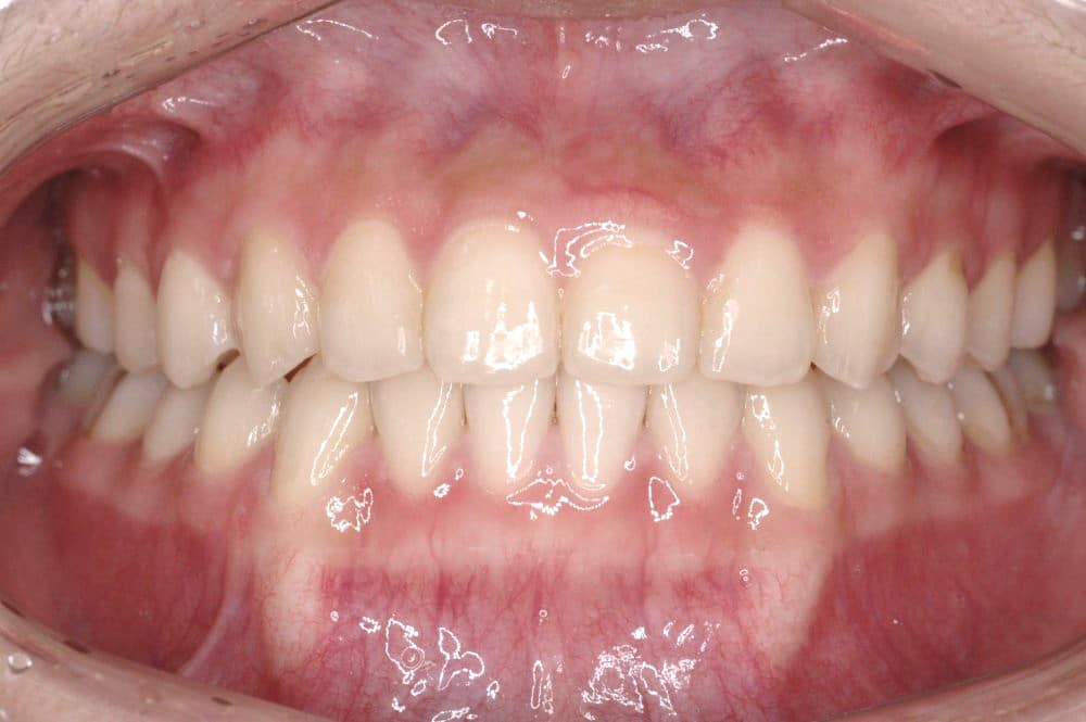 Orthodontic treatment in Brussels - crossbite treated