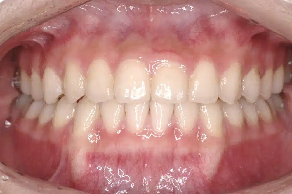 Orthodontic treatment in Brussels - crossbite treated