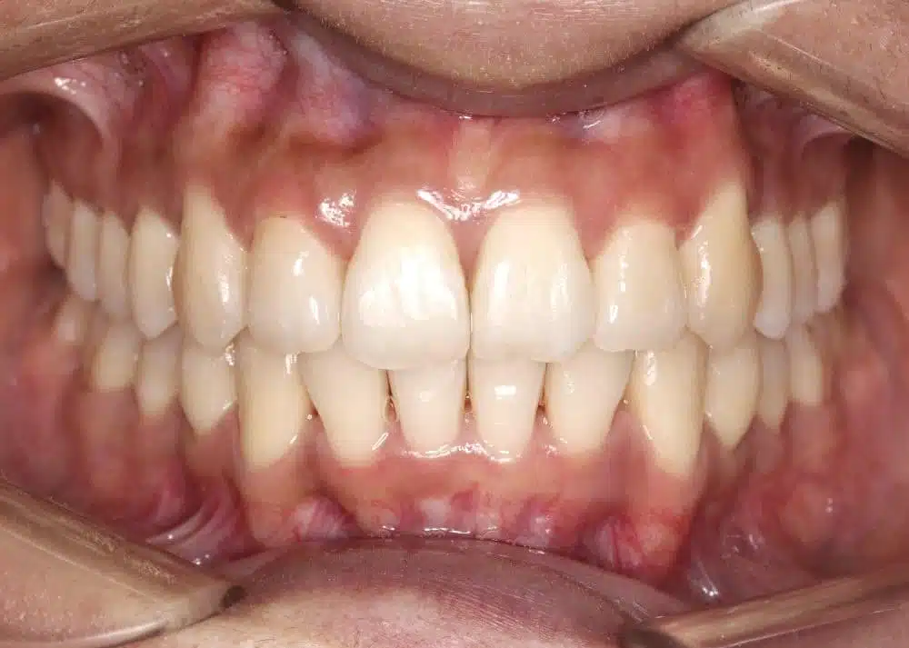 Orthodontic treatment in Brussels - crossbite treated