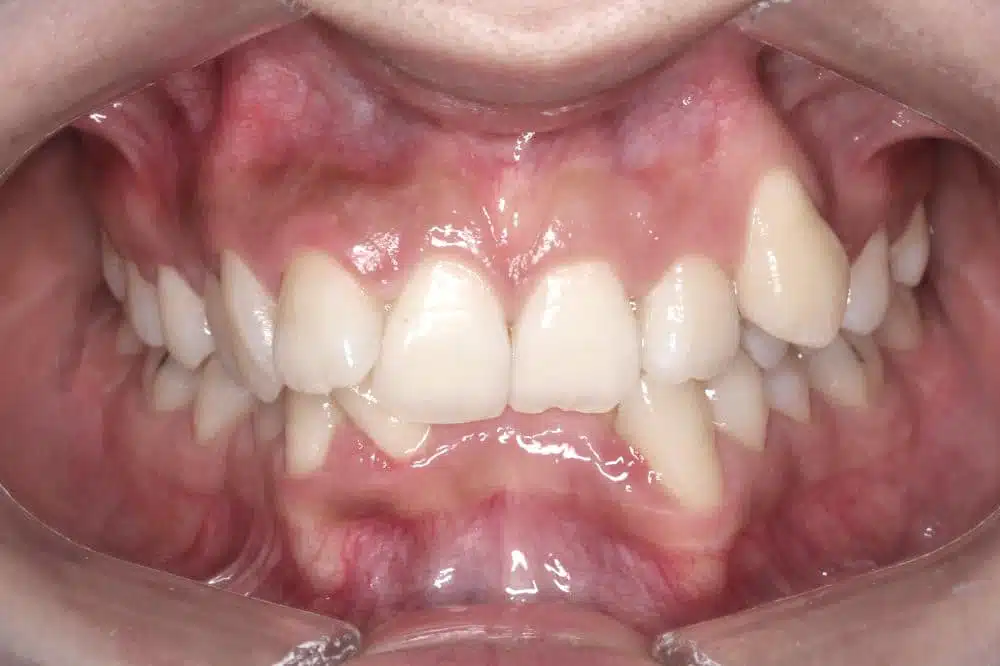 Orthodontic treatment in Brussels - deepbite