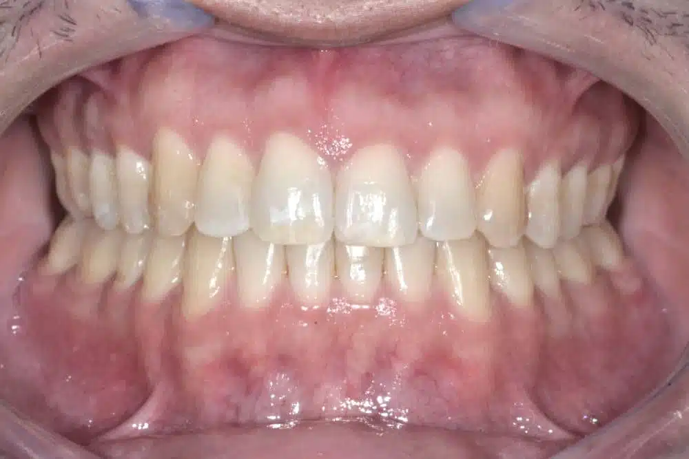 Orthodontic treatment in Brussels - diastema treated