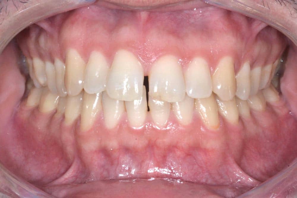 Orthodontic treatment in Brussels - diastema