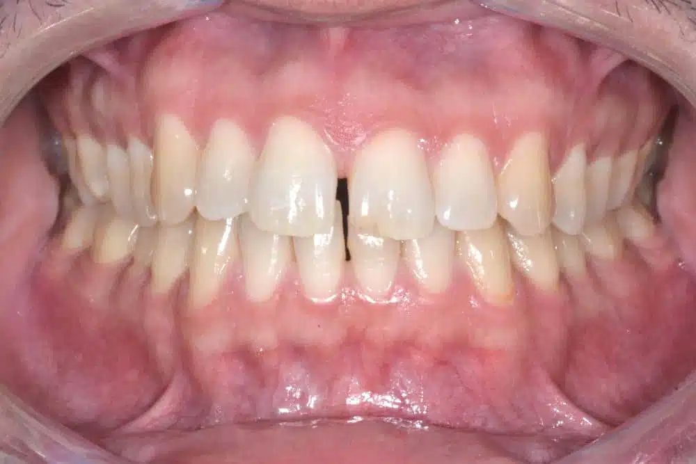 Orthodontische behandeling in Brussel - diastema