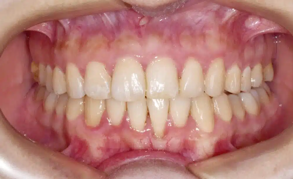 orthodontic treatment in Brussels - large overlap treated