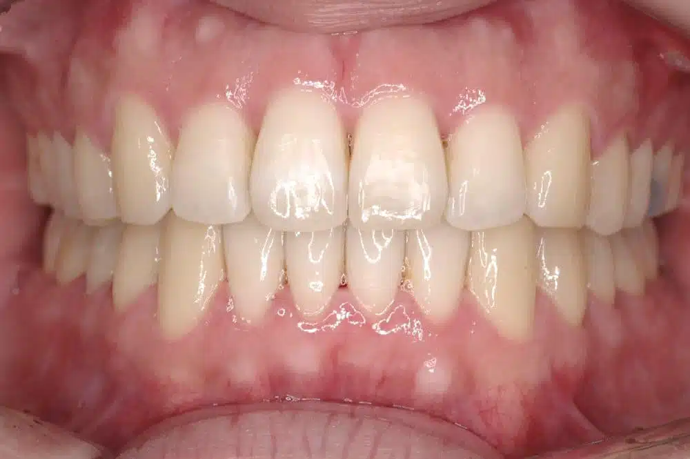 Orthodontic treatment in Brussels - diastema treated