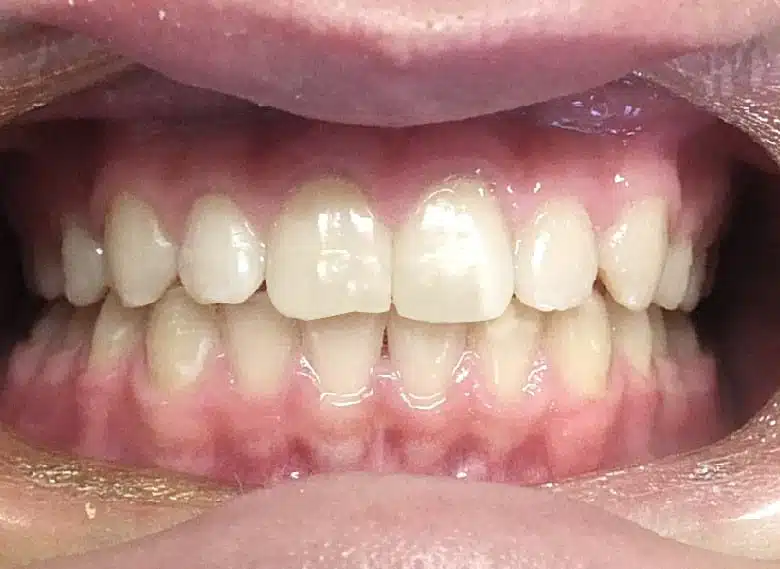 Orthodontic treatment in Brussels - treated overjet