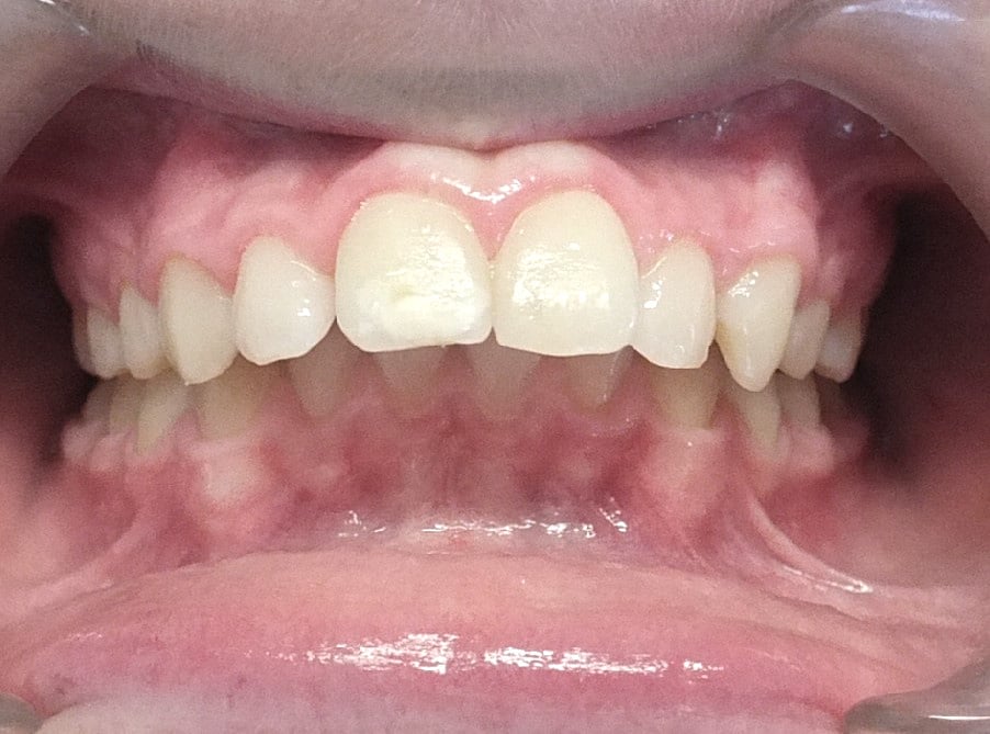 Orthodontische behandeling in Brussel - overjet