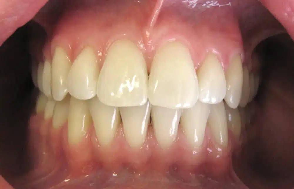 orthodontic treatment in Brussels - small overlap treated