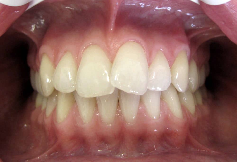 orthodontic treatment in Brussels - small overlap