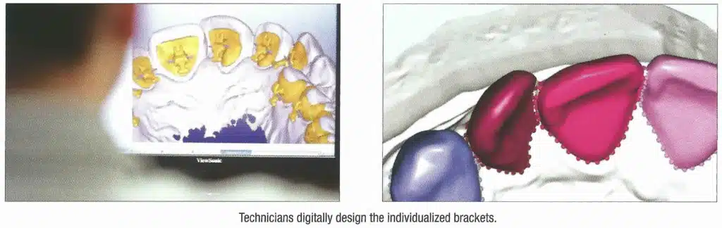 Validatie Linguale orthodontie in Brussel - iDent Clinic