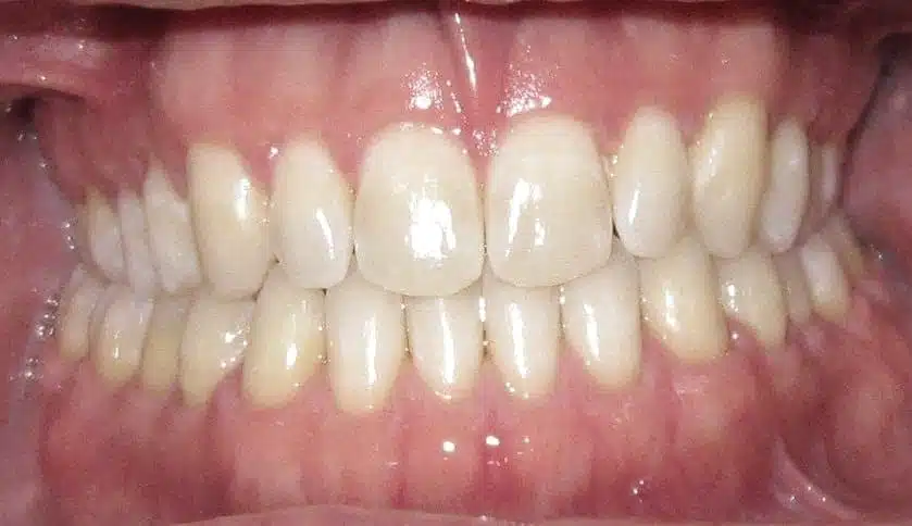 traitement des espaces entre les dents